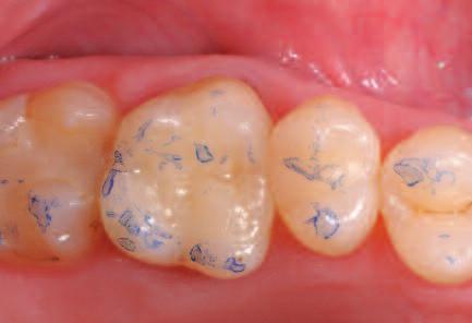If additional characterizations or adjustments are required after crystallization, a corrective firing using IPS e.max CAD Crystall./Shades and Stains and Glaze can be conducted.