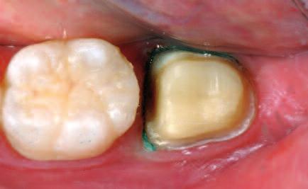 Due to the higher brightness compared with IPS e.max CAD HT, a greying of the restoration is prevented.