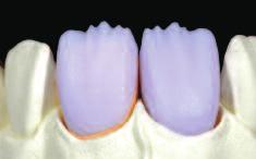 especially in the anterior region, the incisal/occlusal third may be veneered