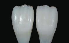 CAD/CAM unit (crown on tooth 11) or by manual reduction (veneer on tooth 21) in