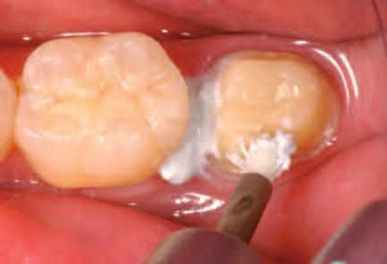 Example: Cementation with