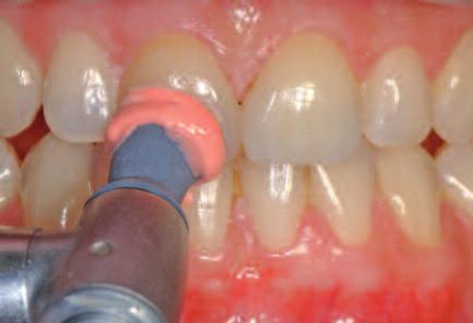 Care instructions Like natural teeth, high-quality IPS e.max CAD restorations require regular professional care.