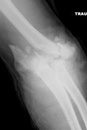 Elbow Fracture with bone