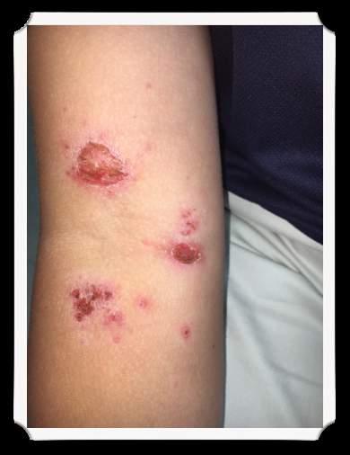 Case #1 13 year old male is sent to your office for evaluation of this rash.
