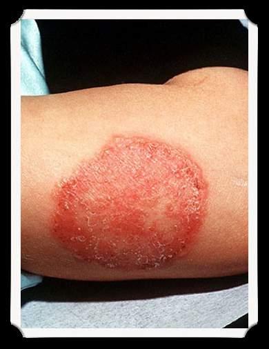 Case #5 6 year old presents with worsening rash over the past week.