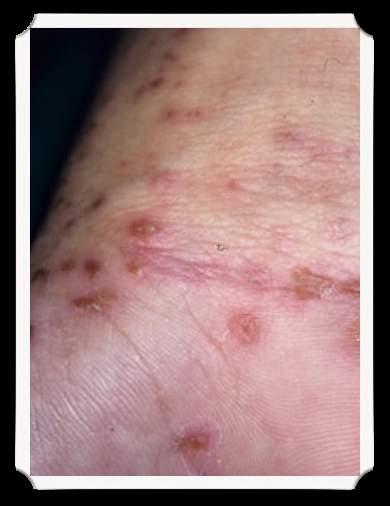 Case#8 12 year old female presents with an intensely itchy rash on her wrists and in her armpits and in her groin.