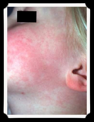 Case #13 An 8 year old comes in with a rash on her cheeks.