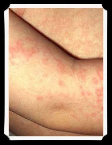 Fifth disease control No longer contagious once rash appears Individuals can be infected and contagious without