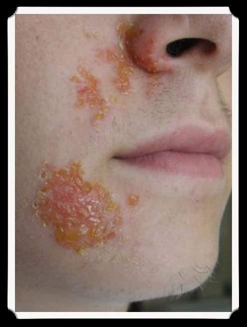 Impetigo Control Wash the affected area, cover lesions then exclude infected individuals at the end of the day until topical, oral or other systemic antibiotics are started.