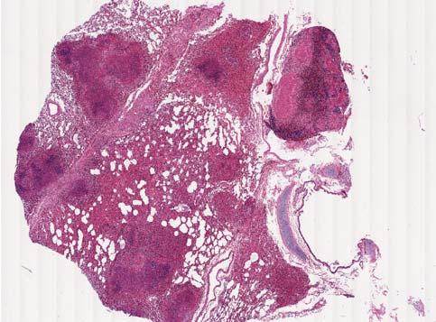 Disseminated Caseating Granuloma Granulomas form, contain and kill MTB as CMI develops ACT 2 The Sneak Attack MTB antigens