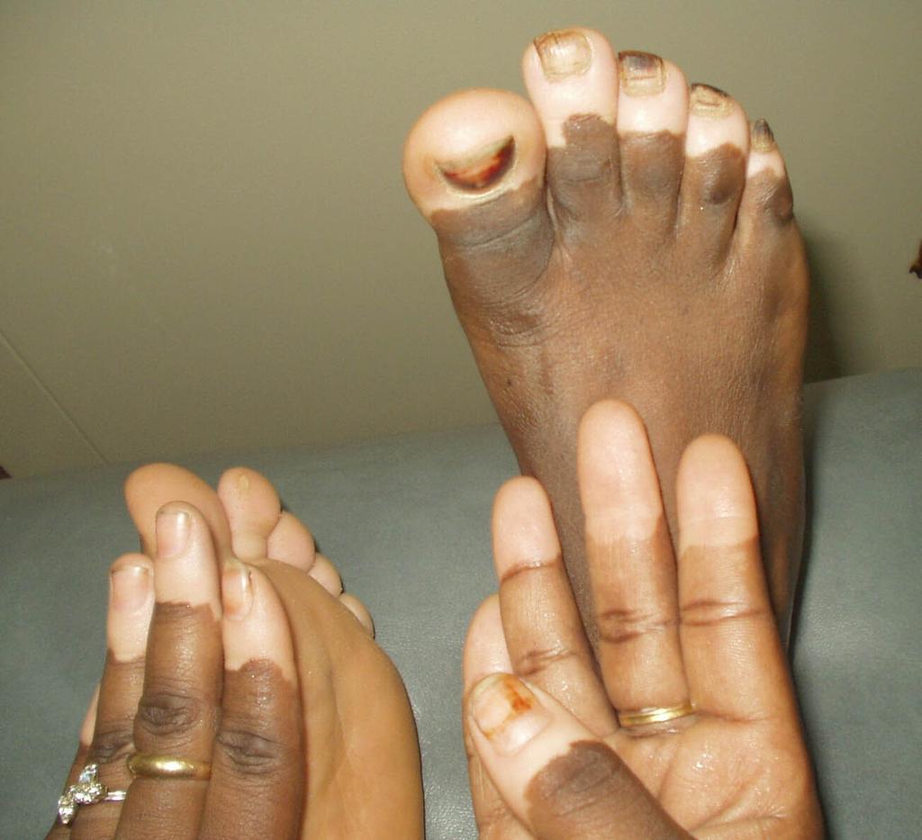 Vitiligo EPIDEMIOLOGY Vitiligo occurs worldwide, with a prevalence of 0.1 percent to 2.0 percent. In the United States, the estimated incidence is 1 percent.