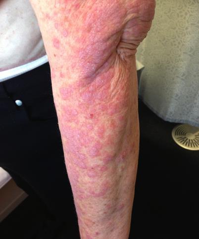 Skin toxicity Rash, pruritus and vitiligo are common Rarely Steven Johnson syndrome Usually manageable with topical steroids,
