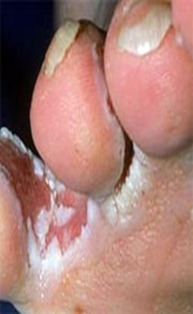 Athlete s Foot A common infection caused by the tinea fungus Symptoms include itching, burning, and cracked, scaly skin between the toes and on the feet It