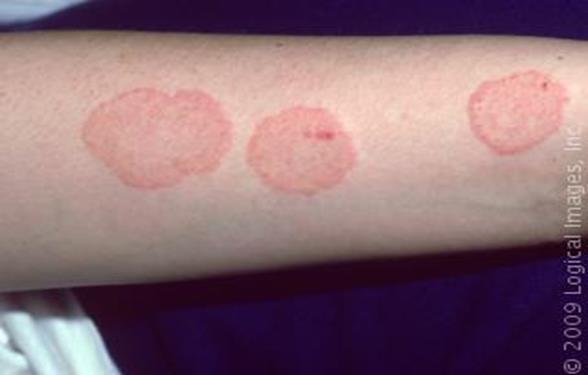 Ringworm Caused by tinea fungus Causes a red skin rash that forms a ring on normal looking