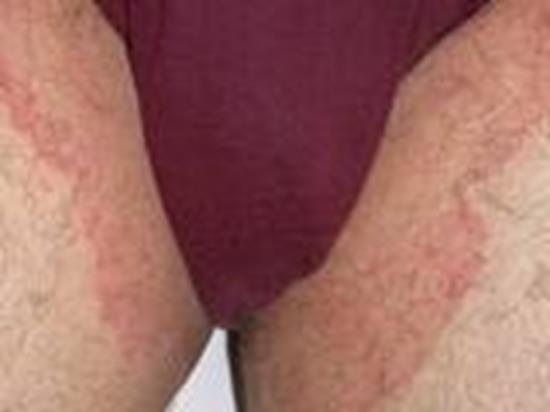 Jock Itch Cause by the tinea fungus Causes an itchy, burning rash in