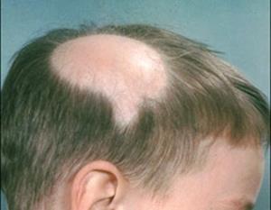 Alopecia (baldness) Causes include genetics, endocrine issues, Causes absence or loss of