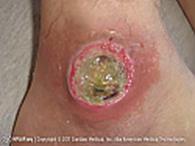 Decubitus Ulcers (bedsores) Caused by long term constant press to one area Causes an open sore (ulcer) usually over a