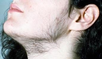 Hirsutism Caused by abnormally high hormone levels or by hair follicles that are more sensitive to normal androgen levels Causes