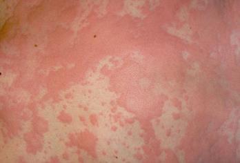 Urticaria (hives) Caused by reaction to allergens or even psychological stress Causes an outbreak of swollen, pale red bumps or plaques