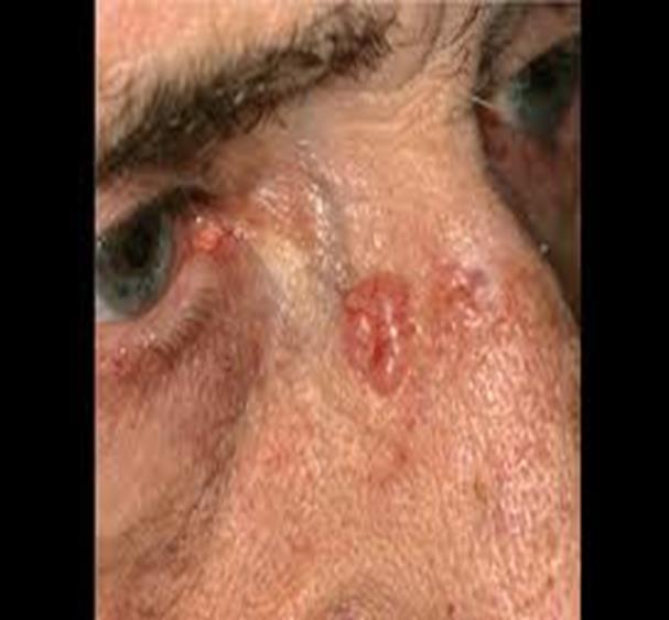 Basal Cell Carcinoma The most common form of cancer 1 million new cases estimated in the U.S. each year Begins in the basal cell layer of the skin.