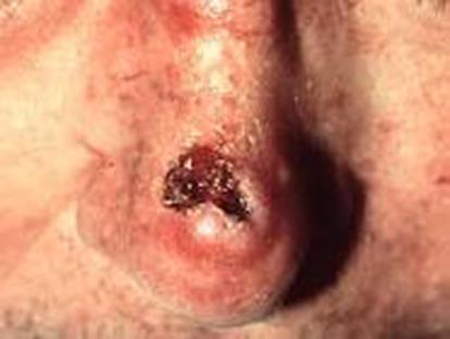 Squamous Cell Carcinoma Begins in squamous cells.