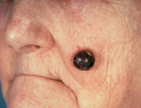 Melanoma Melanoma, the least common but most serious type of skin cancer