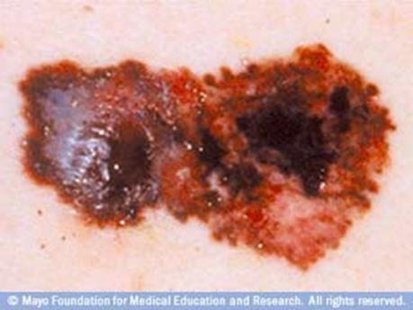 Melanoma can also form in your eyes and, rarely, in internal organs,