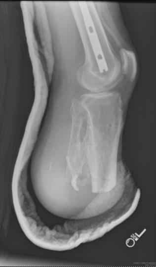 McGuigan, Short-term outcomes of severe open wartime tibial fractures treated with ring external fixation.