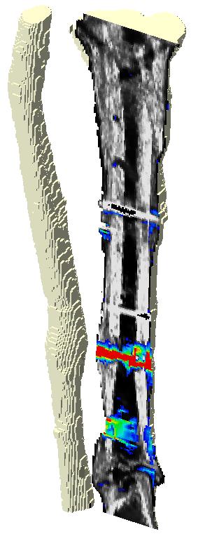 Methods Patient-specific finite element models Virtual stress testing of
