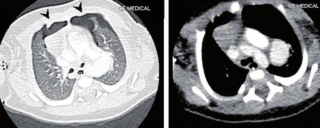 7 * * Fig. 3 Cardiac CT scan (DOL 2) showing the ductal aneurysm measuring 13 mm in diameter (asterisk); in addition, there are bilateral anterior pneumothoraces (arrow heads).