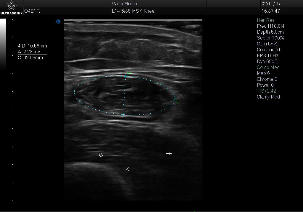 Rectus femoris ultrasound preliminary data Quick Study