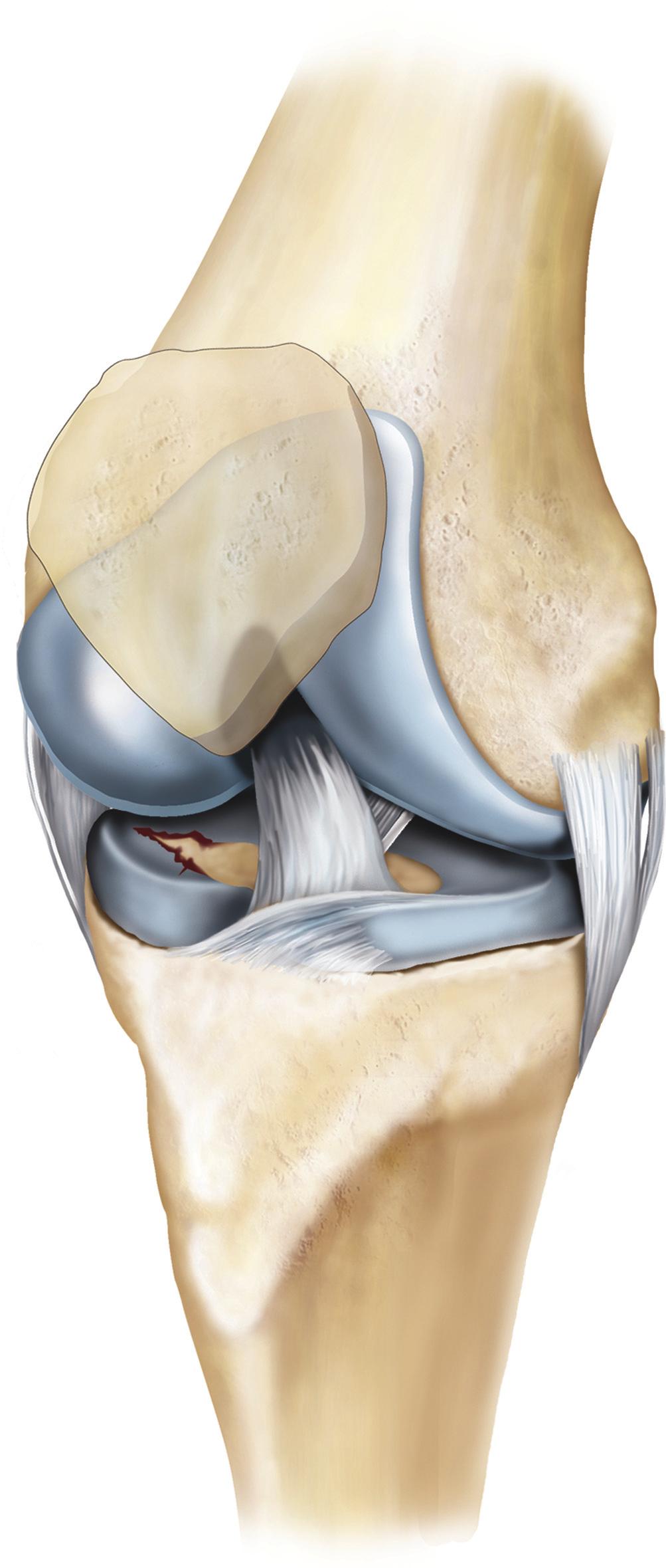 What is an arthroscopy of your knee? An arthroscopy (keyhole surgery) allows your surgeon to see inside your knee using a camera inserted through small cuts in your skin.