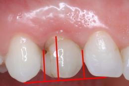 Fig. 2. Immediate implant in the upper right canine extraction socket of a 27 \s old woman. This case was randomized to the submerged group. Table 1.