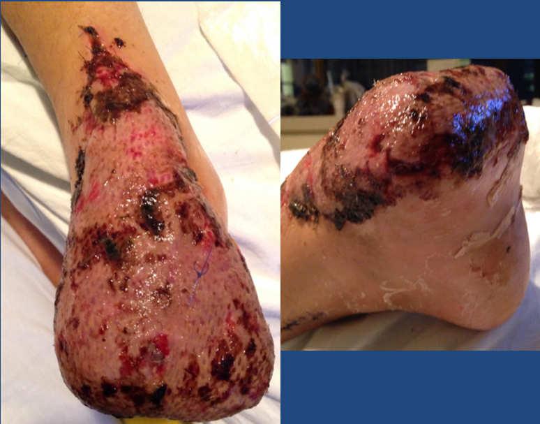 tibial vena commitante. Split thickness skin graft placed over the muscle flap.