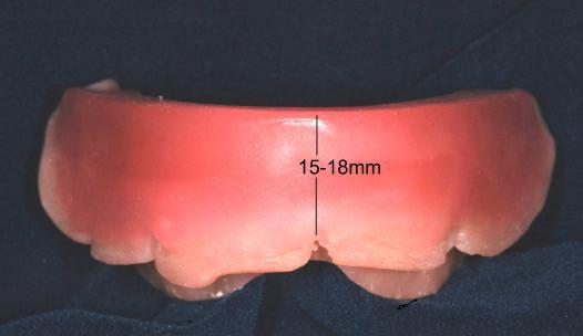 4. Anteriorly and posteriorly, the mandibular wax rim should