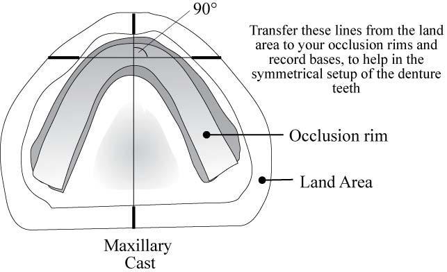 Mandibular Occlusion Rim: 1. The procedure for making the mandibular rim is very similar to that for the maxillary rim.
