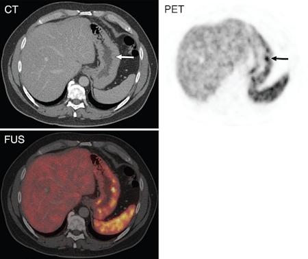 NETS: Diagnostic challenge Gallium scans being offered in more centers, reimbursement and role in care being studied February 21, 2014 -- German researchers have confirmed the efficacy of PET/CT with