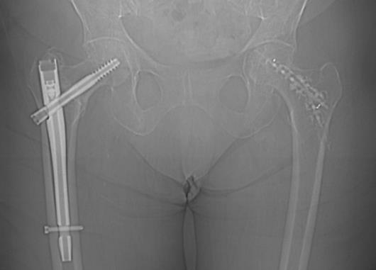 TRAUMATOLOGY INDICATION is indicated for contralateral percutaneous internal fixation of proximal femur, in patient with a low energy pertrochanteric fracture on the first side Unique
