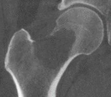 ONCOLOGY INDICATION is indicated for percutaneous internal fixation for impending pathological fracture of proximal femur