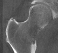 Mirels score: 9 Lytic lesion of the femoral neck Size of lesion 2/3 of the cortical thickness Pain assessment VAS : 4