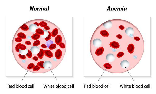 Anemia Decreased RBCs in the blood Caused by: low production, blood loss, iron