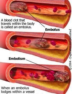 Embolus Embolism Embolus: a clot that is dislodged into the circulatory system If the embolus becomes