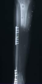K.C.: 28 y/o M s/p MCA Developed Aspergillus osteomyelitis with resultant 22 cm tibial shaft