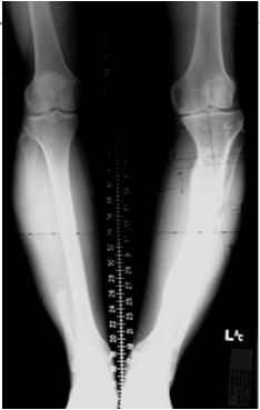 K.H.: 55 y/o F with left knee pain Suffered repetitive fractures
