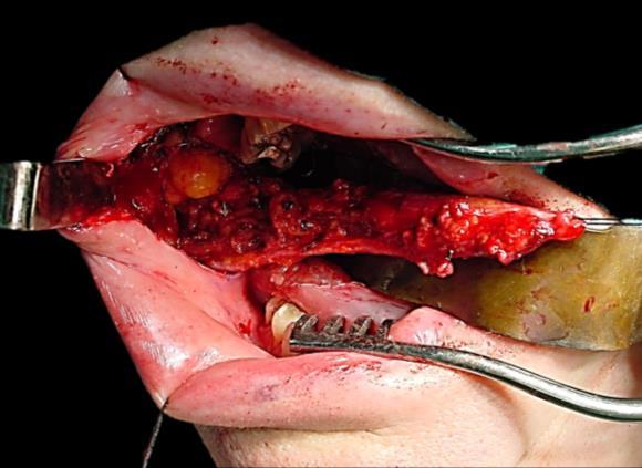 buccopharyngeal fascia, and the flap elevated in an anterior-to-posterior direction up to the pterygomandibular raphe where the neurovascular bundle enters the flap.