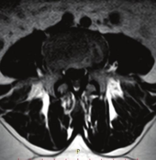 (candd)theextrudeddischasdisappearedcompletely (white arrows) in sagittal and axial MR images after three years; the height of the disc space slightly decreased at L4-5 level and there was no sign of