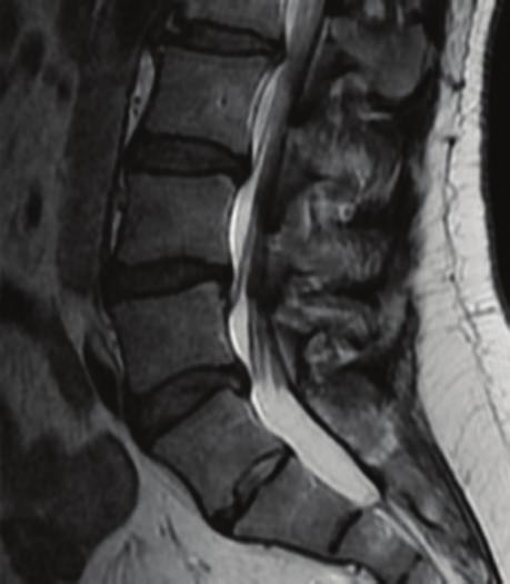 herniated disc side so strongly that the factors leading to new herniations in adjacent levels did not affect them. 4.