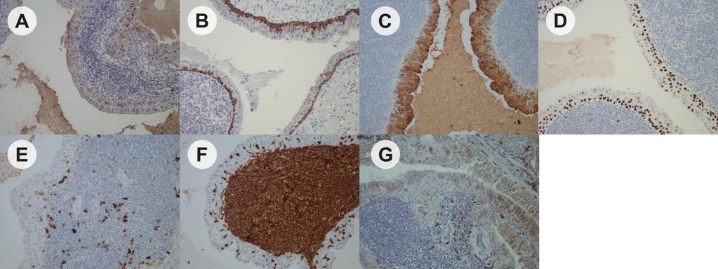 mioepitelnim ćelijama; D Jedarna ekspresija S100; E Citoplazmatska ekspresija vimentina; F Ekspresija WT1 u citoplazmi neoplastičnih mioepitelnih ćelija Epitel u Vartinovom tumoru je dvoredan i čine