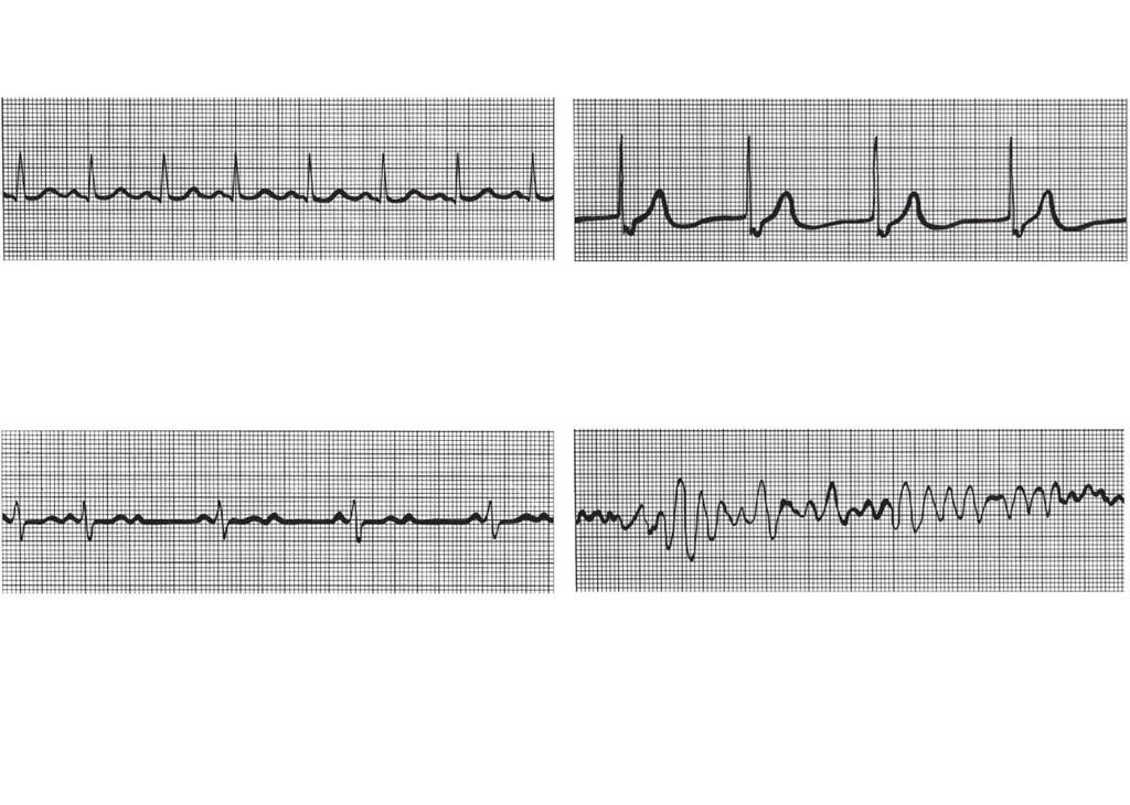 (a) Normal sinus rhythm. (b) Junctional rhythm. The SA node is nonfunctional, P waves are absent, and heart is paced by the AV node at 40-60 beats/min. (c) Second-degree heart block.
