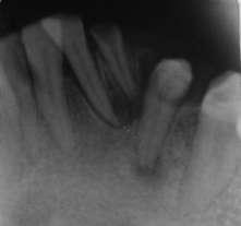 Figure 1: Intra oral view of peripheral odontogenic fibroma in madibular region Figure 5: 1 month post